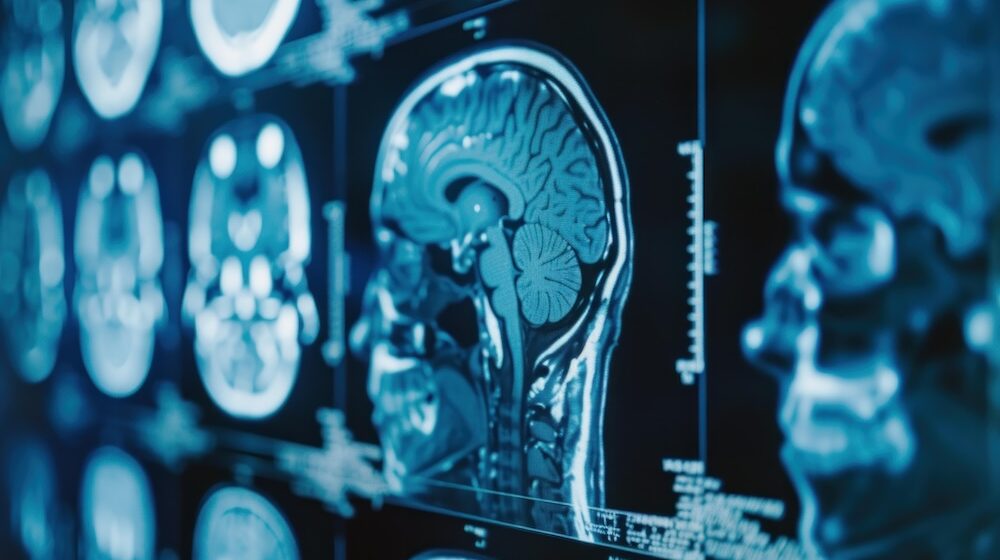 Male sex hormones drive aggressive childhood brain tumour, study finds