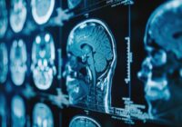 Male sex hormones drive aggressive childhood brain tumour, study finds