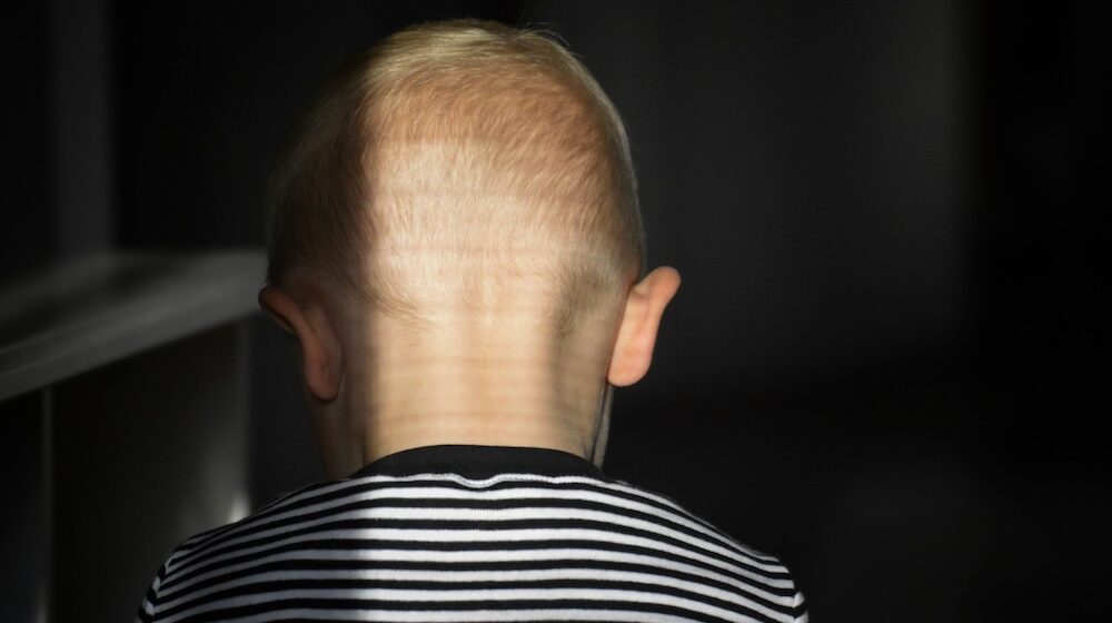 US approves alopecia pill for children aged 12 and over