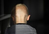 US approves alopecia pill for children aged 12 and over